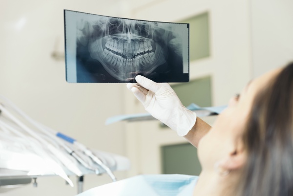 dentist holding up dental x-ray